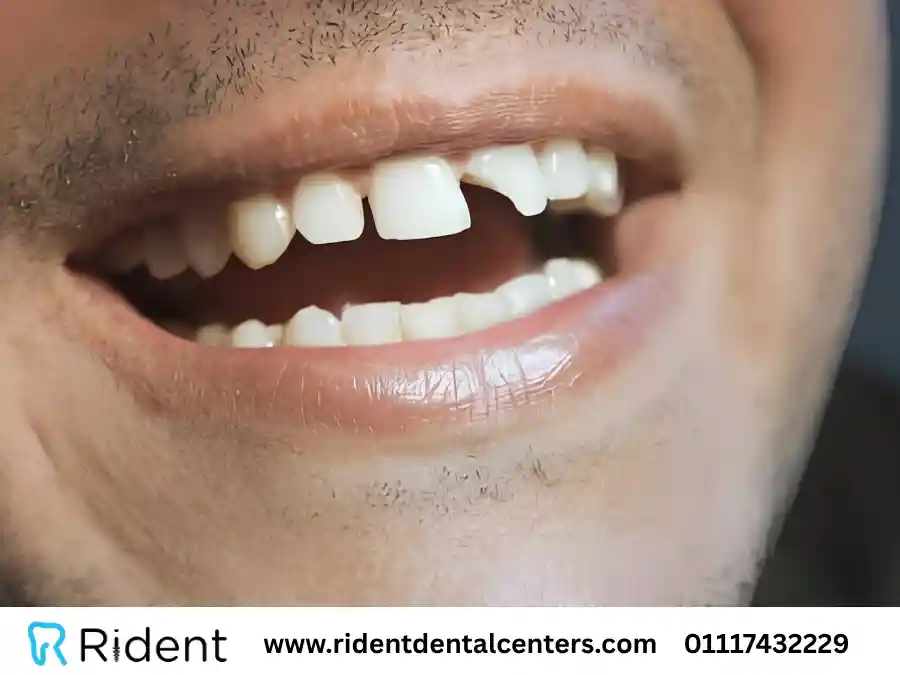 أسباب كسر الاسنان وعلاجه بـ 5 طرق مختلفة